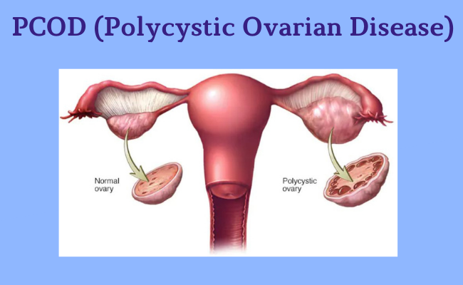 Pcod treatment