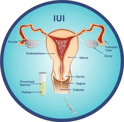 Is IUI the Right Next Step for You?